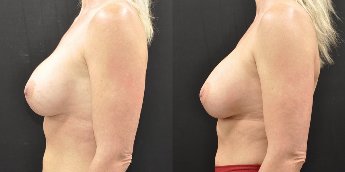 Implant Exchange Before & After Gallery - Patient 259442 - Image 5