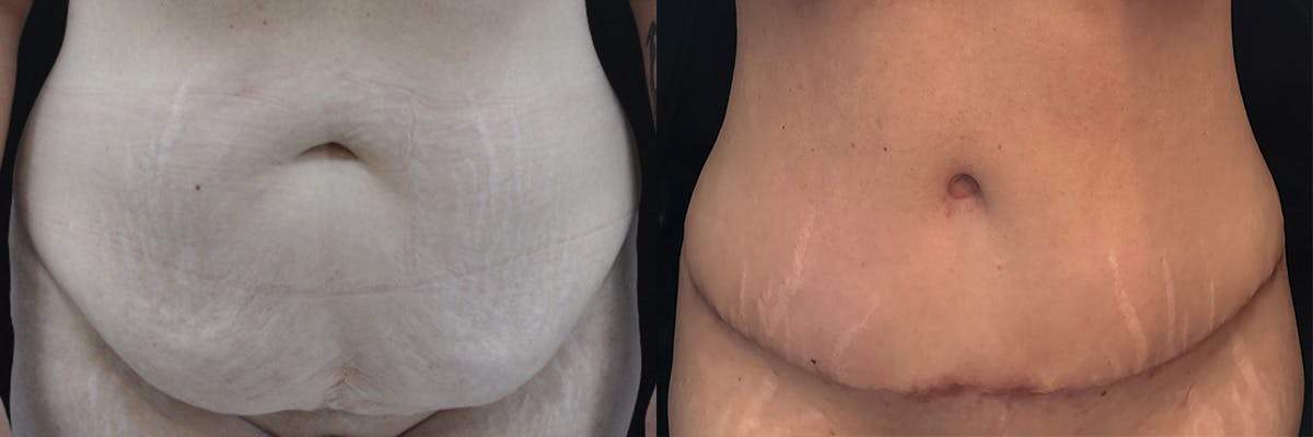 Abdominoplasty Before & After Gallery - Patient 639644 - Image 1