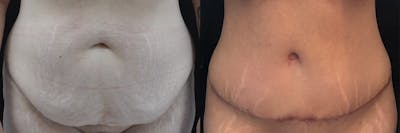 Abdominoplasty Before & After Gallery - Patient 639644 - Image 1