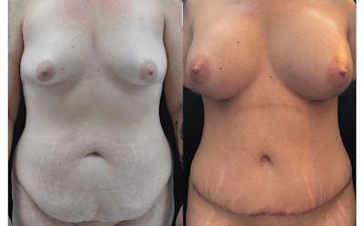Mommy Makeover Before & After Gallery - Patient 403806 - Image 1