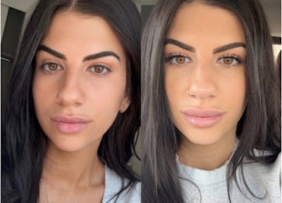 Lip Filler Before & After Gallery - Patient 425953 - Image 1