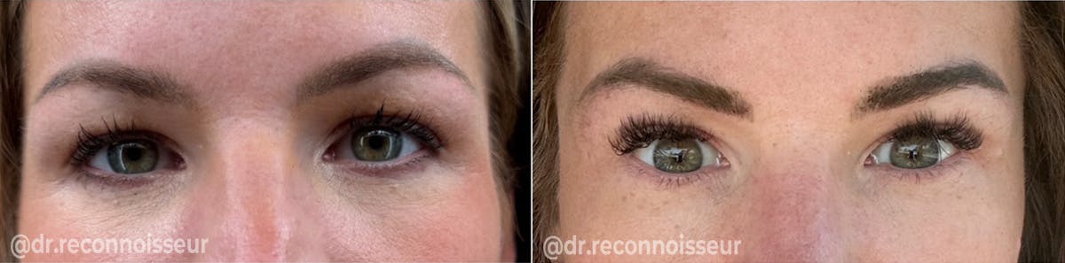 Blepharoplasty (Eyelid Surgery) Before & After Gallery - Patient 278495 - Image 1