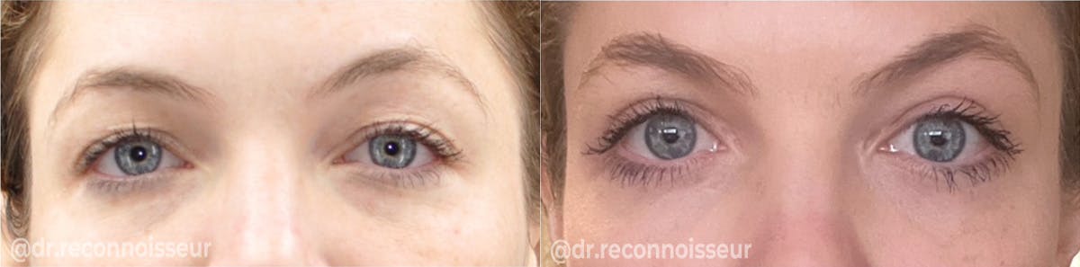 Blepharoplasty (Eyelid Surgery) Before & After Gallery - Patient 193464 - Image 1