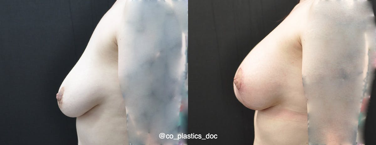 Breast Lift Before & After Gallery - Patient 296519 - Image 5