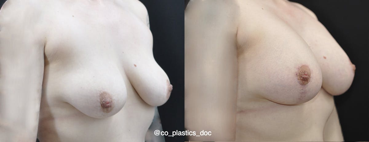 Breast Lift Before & After Gallery - Patient 296519 - Image 2