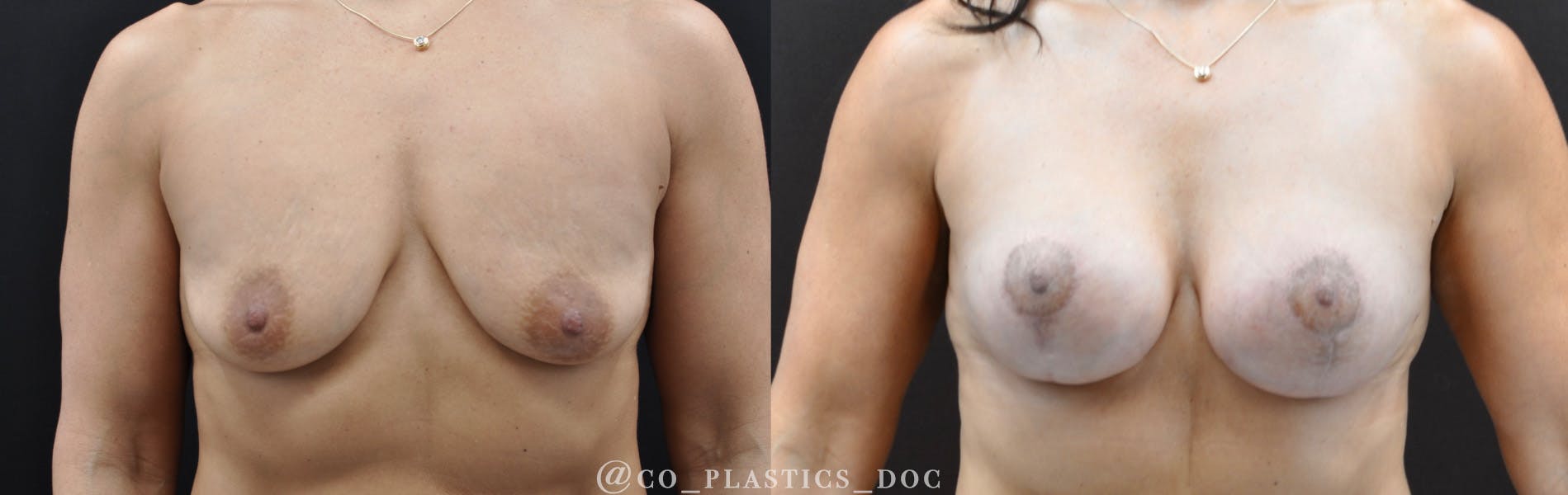 Breast Lift Before & After Gallery - Patient 180252 - Image 1