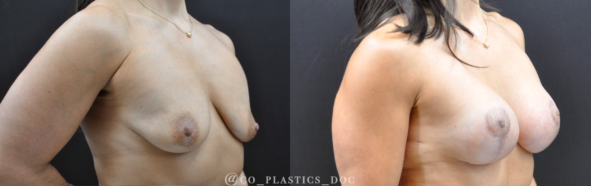 Breast Lift Before & After Gallery - Patient 180252 - Image 2