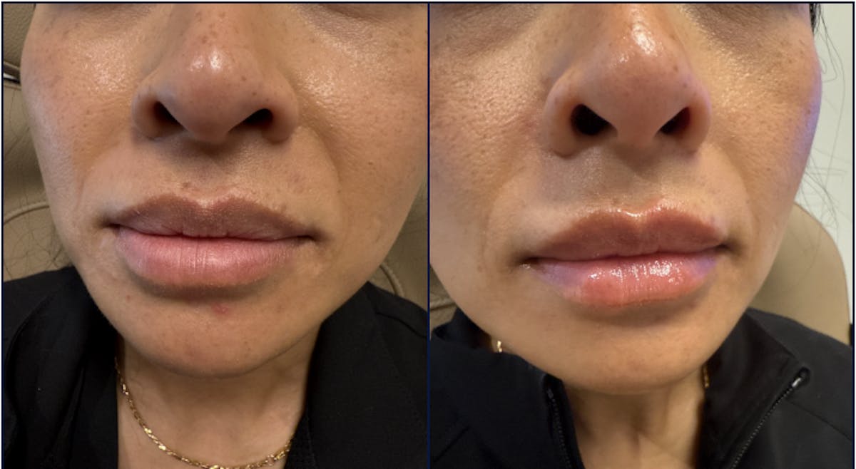 Lip Filler Before & After Gallery - Patient 185340 - Image 1