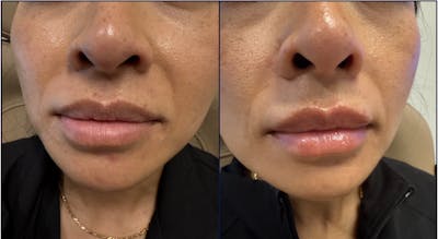 Lip Filler Before & After Gallery - Patient 185340 - Image 1