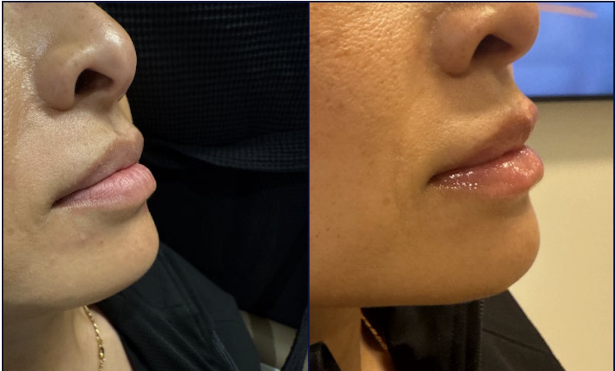 Lip Filler Before & After Gallery - Patient 185340 - Image 2