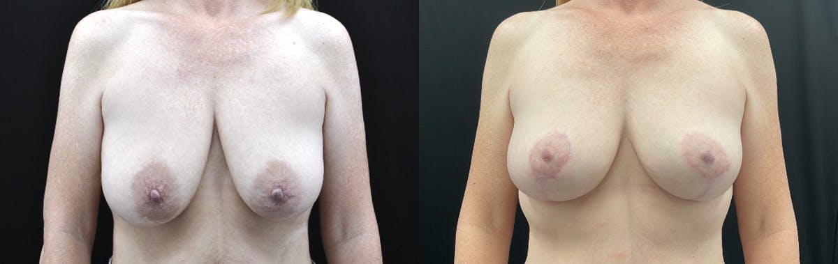 Breast Lift Before & After Gallery - Patient 333616 - Image 1