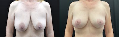Breast Lift Before & After Gallery - Patient 333616 - Image 1