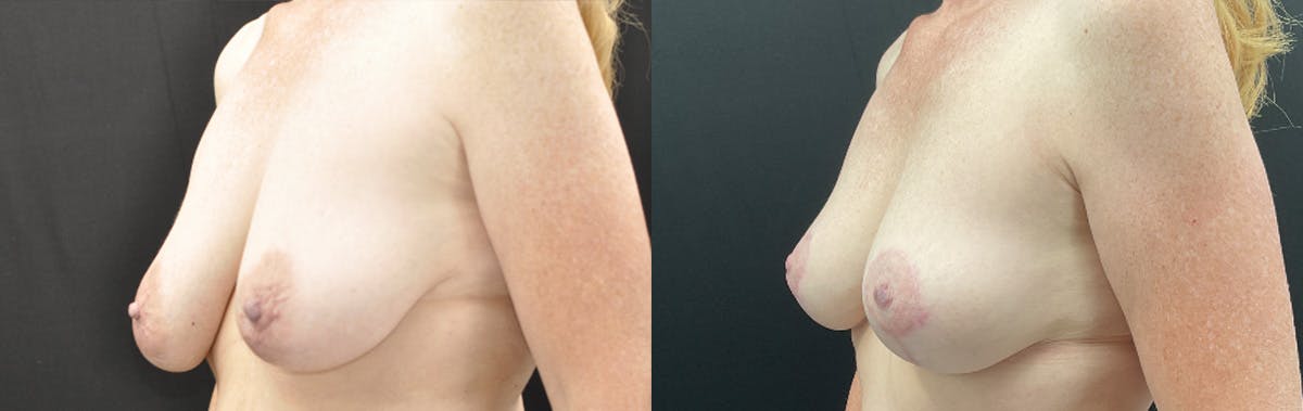 Breast Lift Before & After Gallery - Patient 333616 - Image 2