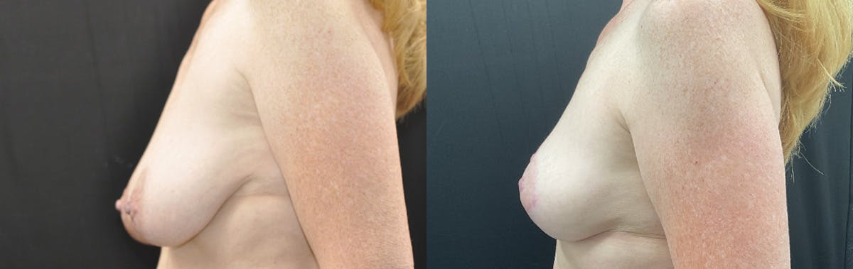 Breast Lift Before & After Gallery - Patient 333616 - Image 3