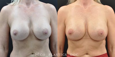 Implant Exchange Before & After Gallery - Patient 259442 - Image 1