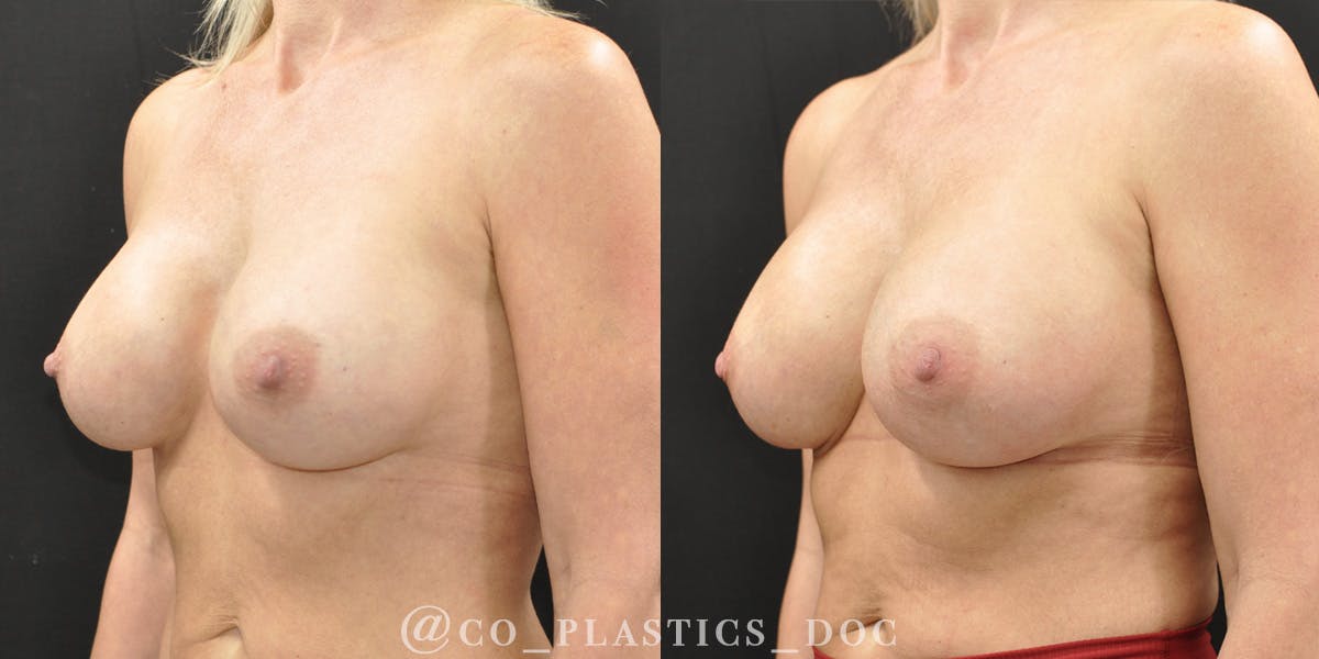 Implant Exchange Before & After Gallery - Patient 259442 - Image 4