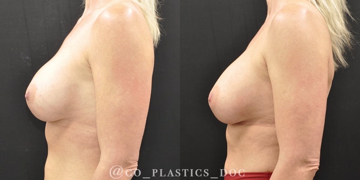 Implant Exchange Before & After Gallery - Patient 259442 - Image 5
