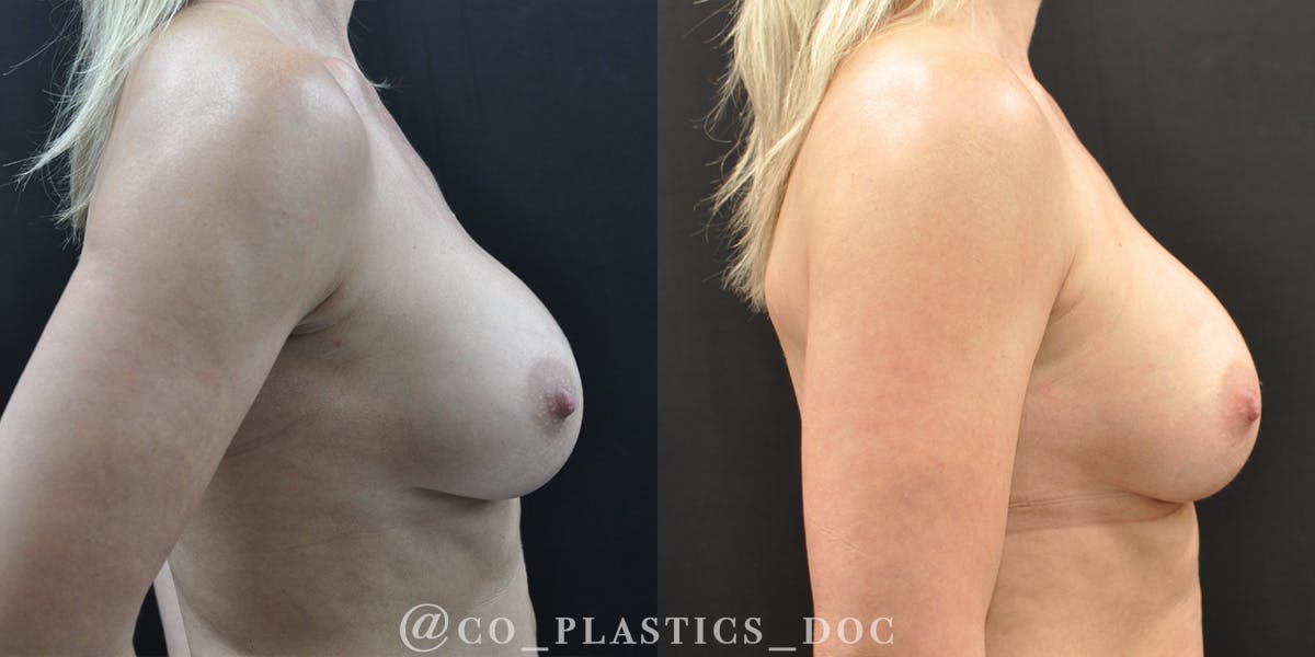 Implant Exchange Before & After Gallery - Patient 259442 - Image 3