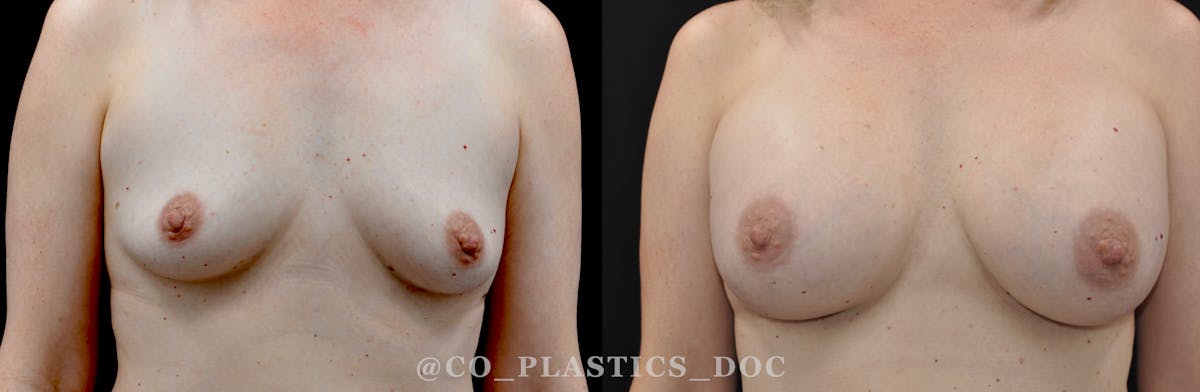 Breast Augmentation Before & After Gallery - Patient 158286 - Image 1