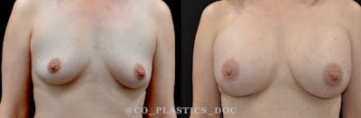Breast Augmentation Before & After Gallery - Patient 158286 - Image 1