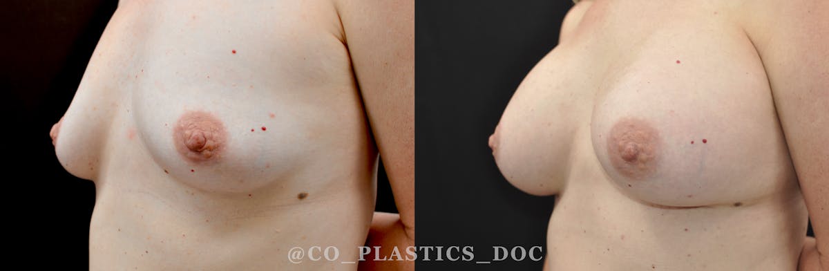 Breast Augmentation Before & After Gallery - Patient 158286 - Image 2