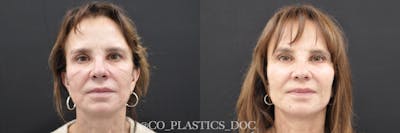 Facial Fat Transfer Before & After Gallery - Patient 148465 - Image 1