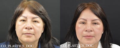 Blepharoplasty (Eyelid Surgery) Before & After Gallery - Patient 253774 - Image 1