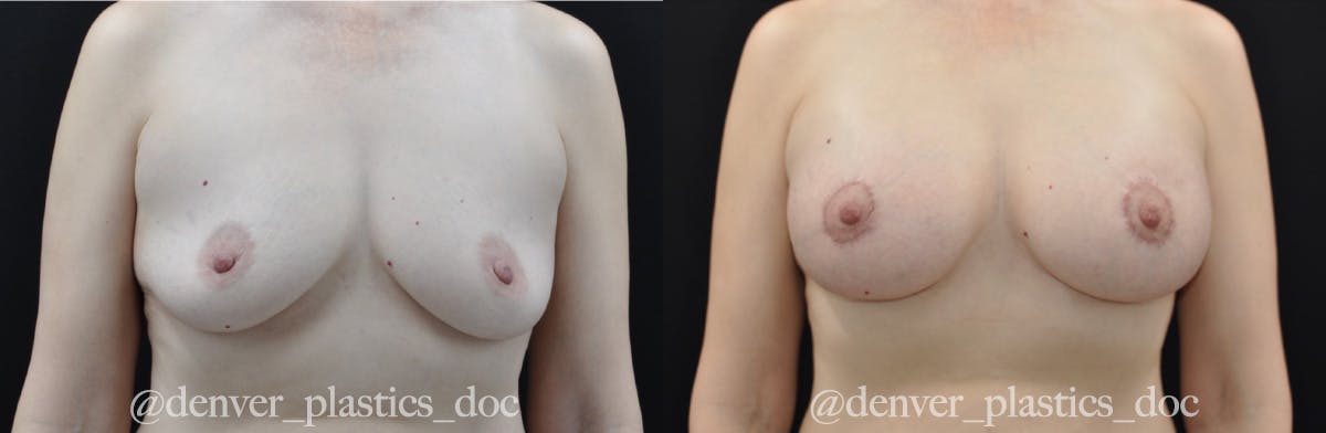 Breast Augmentation Before & After Gallery - Patient 362101 - Image 1