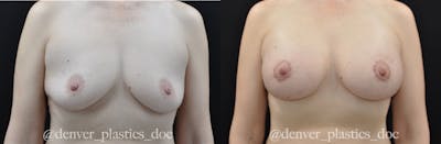 Breast Augmentation Before & After Gallery - Patient 362101 - Image 1