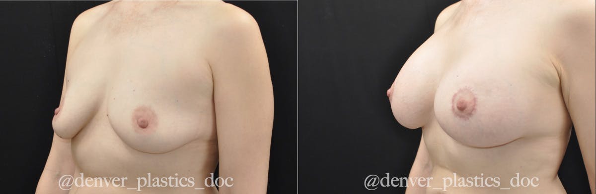 Breast Augmentation Before & After Gallery - Patient 362101 - Image 2