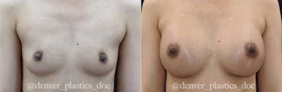 Breast Augmentation Before & After Gallery - Patient 289113 - Image 1