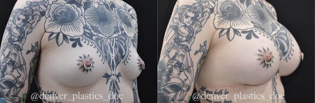 Breast Augmentation Before & After Gallery - Patient 825577 - Image 2