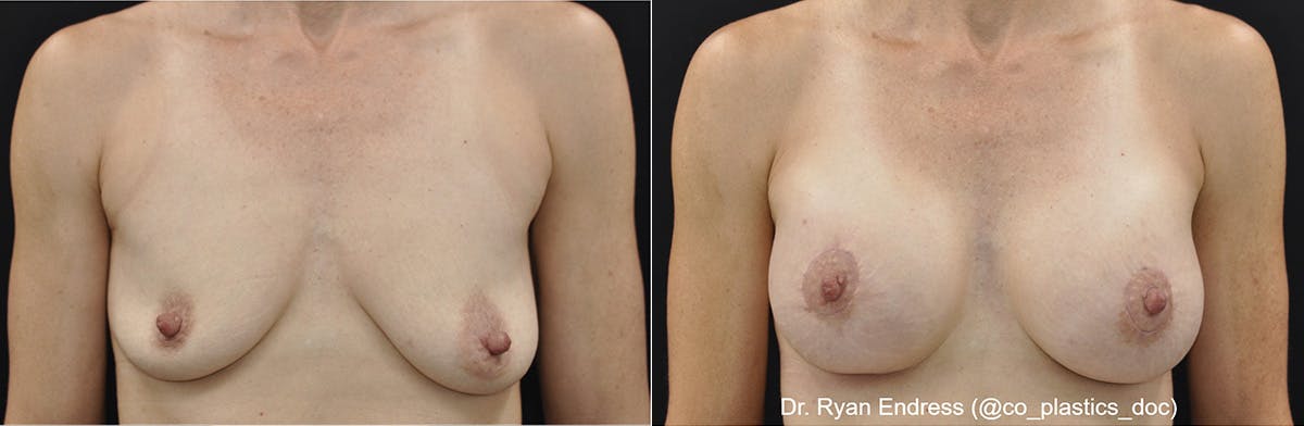 Breast Augmentation Before & After Gallery - Patient 282597 - Image 1
