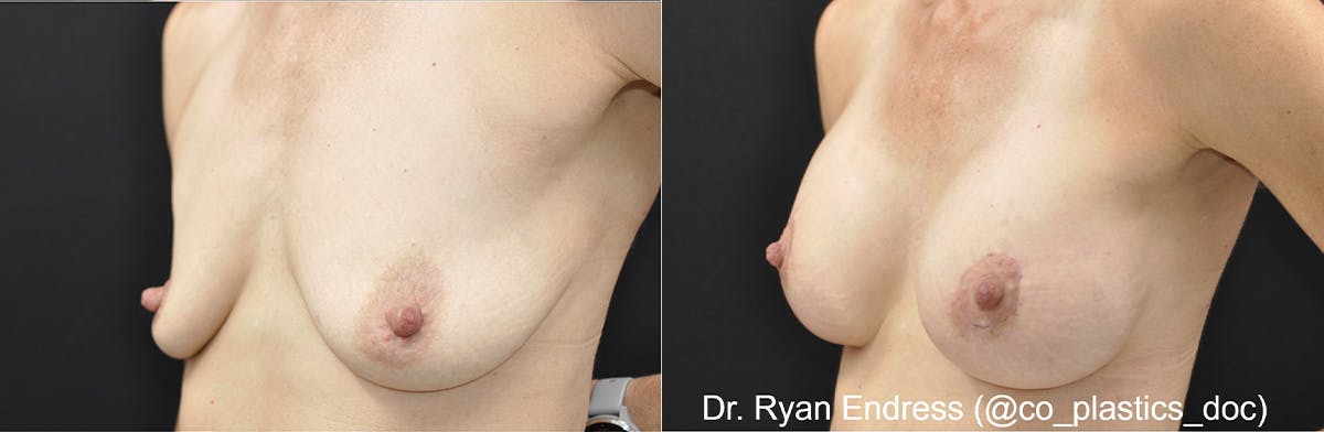 Breast Augmentation Before & After Gallery - Patient 282597 - Image 2