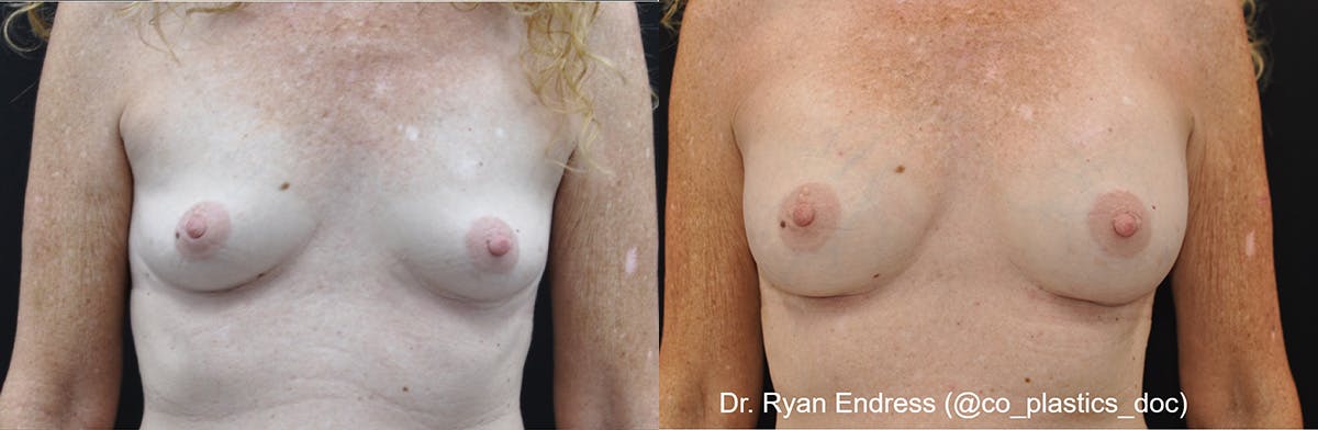 Breast Augmentation Before & After Gallery - Patient 169829 - Image 1