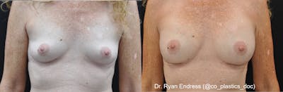 Breast Augmentation Before & After Gallery - Patient 169829 - Image 1