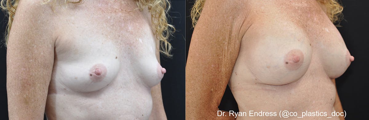 Breast Augmentation Before & After Gallery - Patient 169829 - Image 2