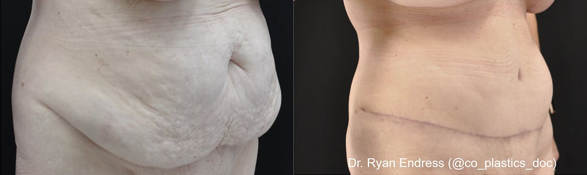 Abdominoplasty Before & After Gallery - Patient 162525 - Image 2