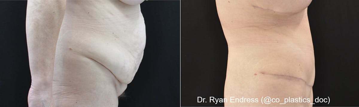 Abdominoplasty Before & After Gallery - Patient 162525 - Image 3