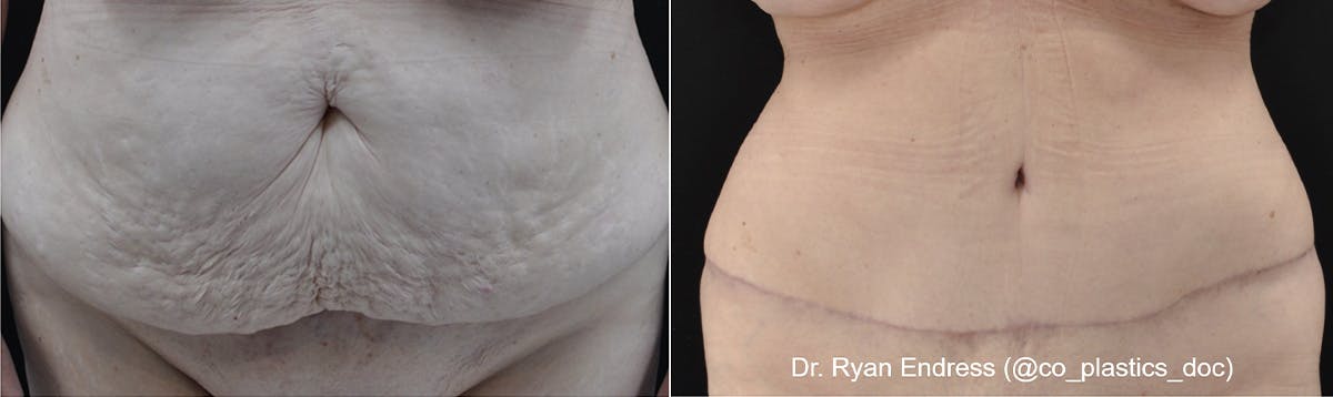 Abdominoplasty Before & After Gallery - Patient 162525 - Image 1