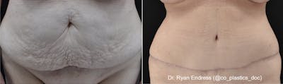 Abdominoplasty Before & After Gallery - Patient 162525 - Image 1