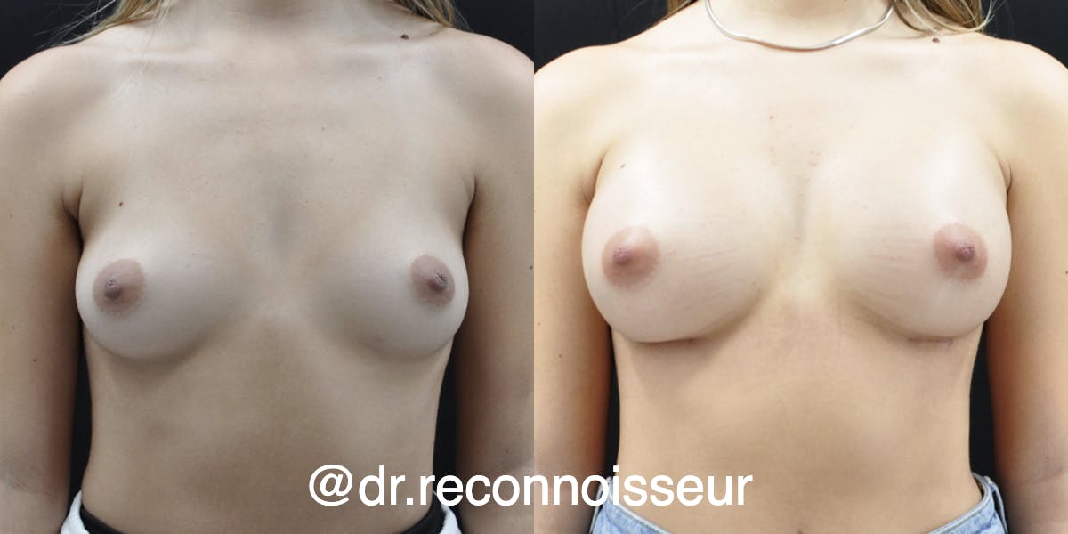 Breast Augmentation Before & After Gallery - Patient 283714 - Image 1