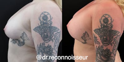 Breast Augmentation Before & After Gallery - Patient 142623 - Image 1