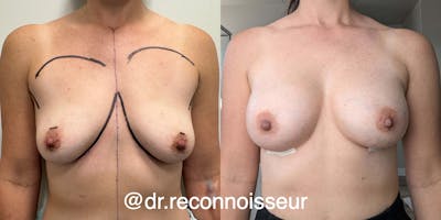 Breast Augmentation Before & After Gallery - Patient 408747 - Image 1
