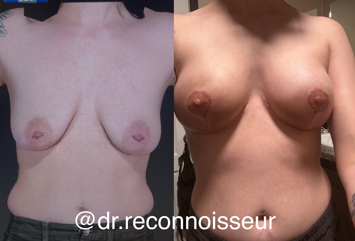Breast Augmentation Before & After Gallery - Patient 200613 - Image 1