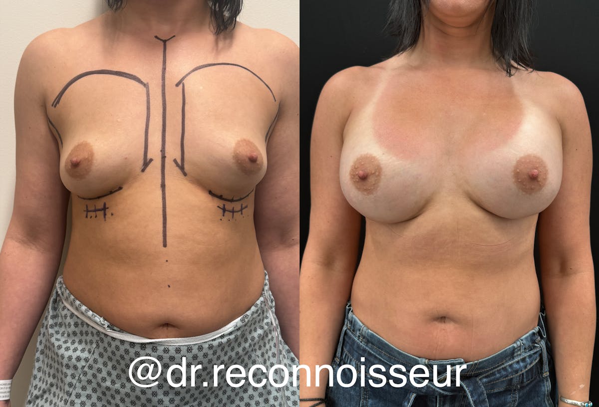 Breast Augmentation Before & After Gallery - Patient 116215 - Image 1