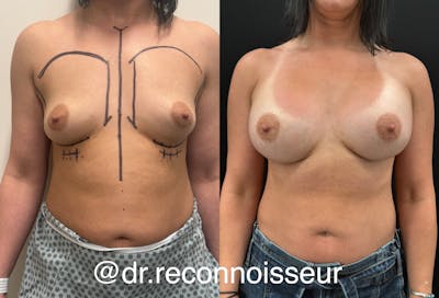 Breast Augmentation Before & After Gallery - Patient 116215 - Image 1