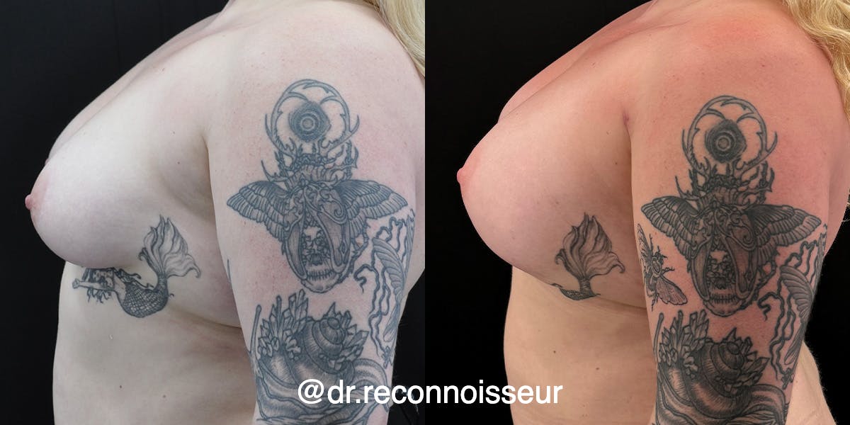 Liposuction Before & After Gallery - Patient 470461 - Image 1