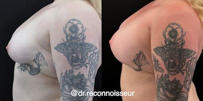 Liposuction Before & After Gallery - Patient 470461 - Image 1