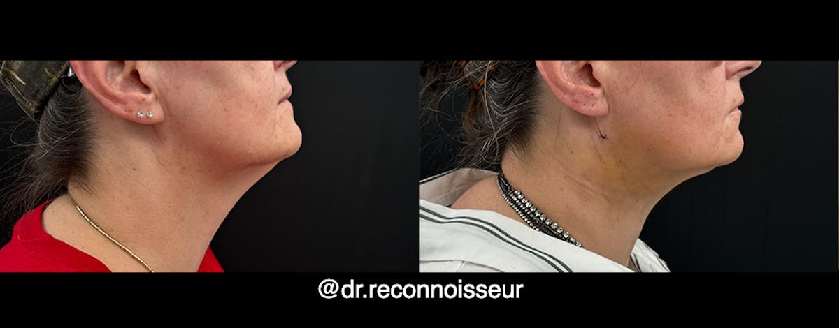 Neck Lift - Neck Vaser Lipo Before & After Gallery - Patient 130840 - Image 1